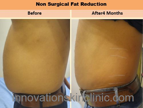 Fat Reduction 2
